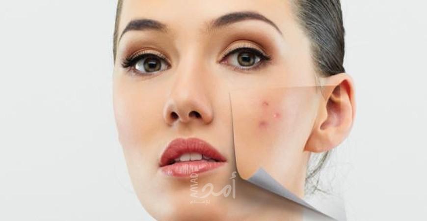 أسباب حب الشباب بعد الثلاثين