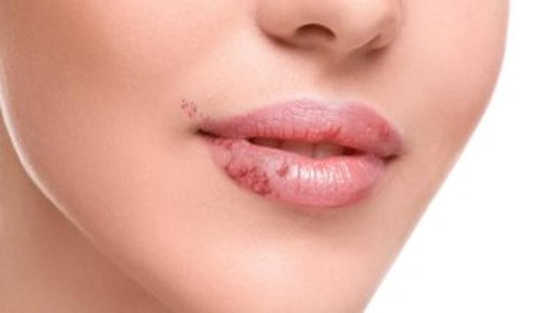 كل ما تريد معرفته عن الهربس البسيط