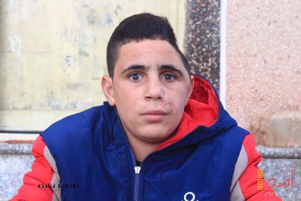 الطفل محمد التميمي يجري عملية في الدماغ تكللت بالنجاح