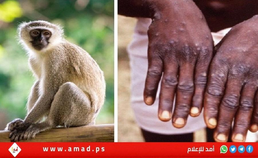 الصحة العالمية: لا ضرورة للتطعيم الجماعي ضد "جدري القرود"