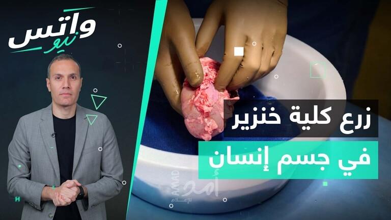 لأول مرة.. جراحون أمريكيون نجحوا بزراعة كلية خنزير في جسم إنسان