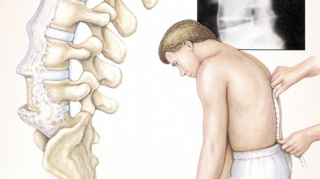 نصائح لتجنب الانزلاق الغضروفى وحماية ضهرك