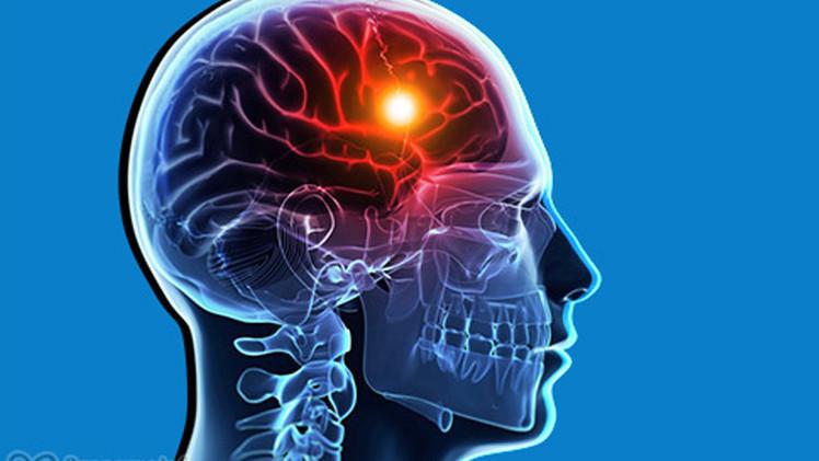 ما لا تعرفه عن السكتة الدماغية الصامتة