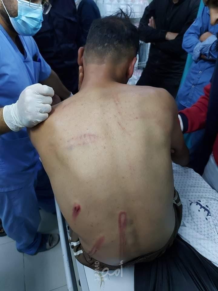 رامي عابد جريح من رفح يكشف تفاصيل اعتداء شرطة حماس عليه - فيديو وصور