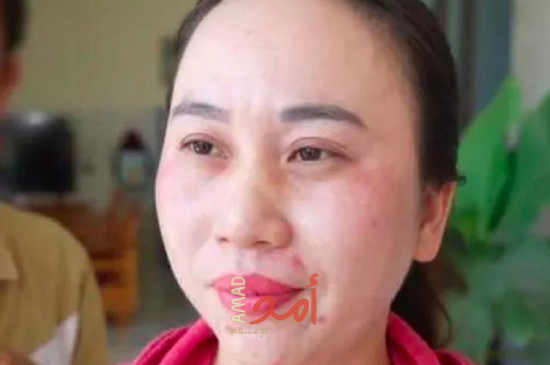 فيتنامية لم تذق طعم النوم منذ أكثر من (11) عاماً
