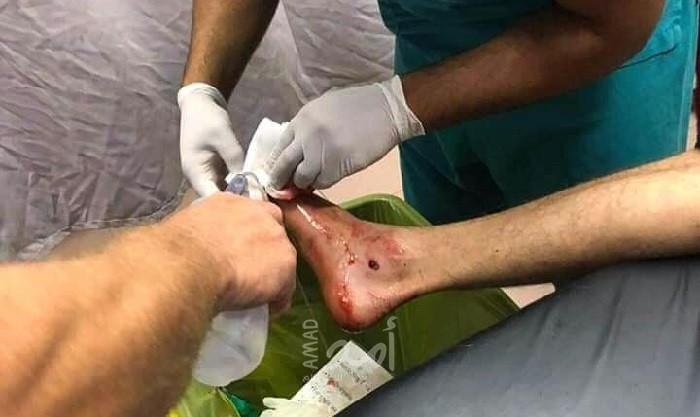 إصابة شاب برصاص جيش الاحتلال جنوب طولكرم