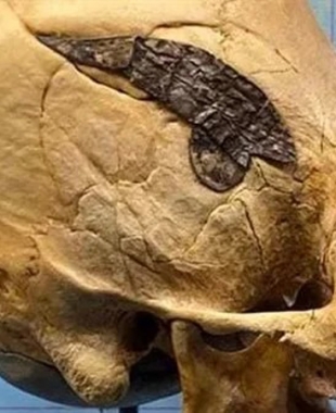 العثور على أول جمجمة خضعت لعملية جراحية منذ 2000 عام